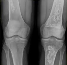 The Radiology Assistant Sclerotic Tumors In 2020 Tumor Pathology Radiology