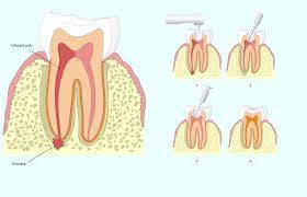 Remember, buying dental insurance does not have to be a painful process. Does Insurance Cover The Cost Of Root Canal Therapy Palm Desert Ca