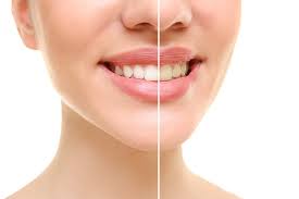 Toothpaste is an item that everyone should have on their shopping list. Teeth Whitening Healthy Smile Dental