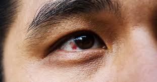 Symptoms can be so vague that you may not notice them. Red Spot On Eye Causes And Treatment