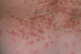 Image result for skin rash similar to scabies