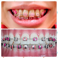 These values can help you match the specific shade you are looking for and even help you find complementary colors. Pink And Lime Green Braces
