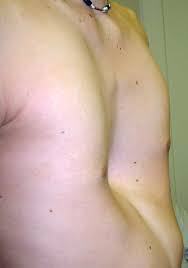 Pectus excavatum is a condition in which a person's breastbone is sunken into his or her chest. Pectus Excavatum Pediatric Surgeons Of Phoenix