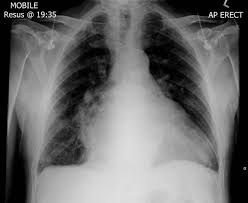 Image result for XRay Changes in Rheumatic Conditions