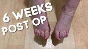 6 Weeks After Bunion Surgery - Youtube