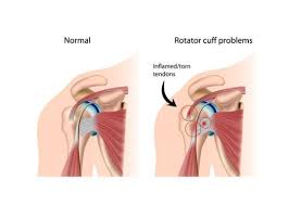 Related online courses on physioplus. Rotator Cuff Injury Tear Tendonitis Shoulder Specialist Boise Meridian Nampa Id