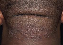 Image result for folliculitis symptoms