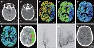 This article provides corporate accounting professionals with an overview of cvas followed by. Stroke The Lancet