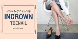 How to get rid of an ingrown toenail overnight. How To Get Rid Of An Ingrown Toenail Overnight Easy Fast