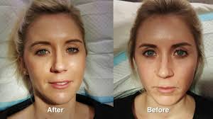 We share some before and after pictures of a treatment and even squeeze out a. Juvederm Rejuvenation W Before After Pictures Youtube