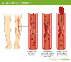 Internistin, kassenpatienten, privatpatienten und selbstzahler. Thrombose Ursachen Symptome Diagnose Behandlung