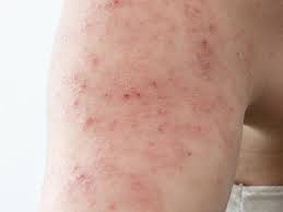 Image result for dermatitis contacta allergica