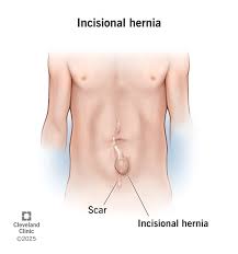 Image result for Hernia Reduction