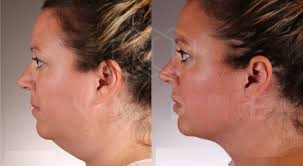 Top Thermage Providers in Cumming, GA