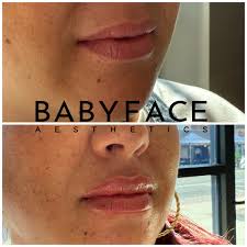 Nothing like a fresh lip💉🤍 #lips #lip #lipfiller #filler #hyaluronicacid  #fillers #longislandaesthetics #aesthetics #babyface #beforeandafter  #naturallips #natural #naturalresults #nurseinjector #injector #aesthetics