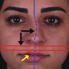 Nasal Base Retraction: A Treatment Algorithm