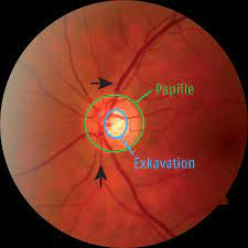 (eye disease) grüner star adj + nm (medizin)glaukom nn nomen, sächlich, neutrum: Nicht Nur Eine Sache Des Drucks