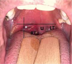 Image result for Peritonsillar Abscess