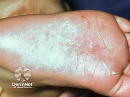 Image result for scabies on human skin