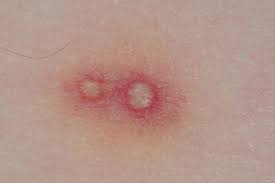 Image result for ant bite