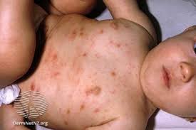 Image result for human scabies