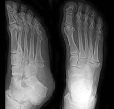 Jones Fractures – Core Em