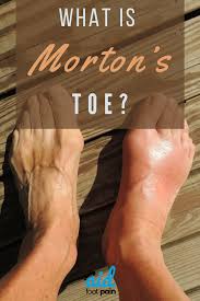 What Is Morton S Toe Morton S Toe Fitness Workout For Women Toe Numbness