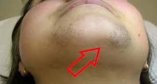 It's applied directly to the affected area of your face twice a day. Get Rid Of Facial Hair Forever This Recipe Solves The Problem Healthy And Natural Life Unwanted Facial Hair Remove Unwanted Facial Hair Unwanted Hair