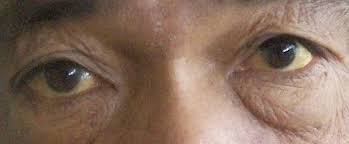 How to improve vision and eyesight naturally in hindi in this video we have explained how to increase eyesight in hindi or eye. Eye Exercises And Eye Yoga Techniques Benefits Limitations