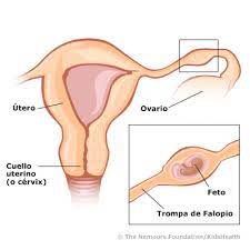 Embarazo Ectopico Para Padres Nemours