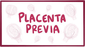 What are the signs and symptoms of placental abruption? Placenta Previa Causes Symptoms Diagnosis Treatment Pathology Youtube