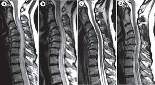 Image result for Myelitis