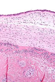 Image result for Chorioamnionitis