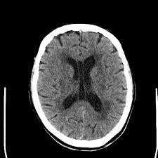 Chronic Small Vessel Ischemia Radiology Case Radiopaedia Org