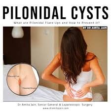 Image result for Pilonidal Cyst