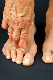 Maybe you would like to learn more about one of these? 6 Sneaky Symptoms Of Diabetes Clifton Foot And Ankle