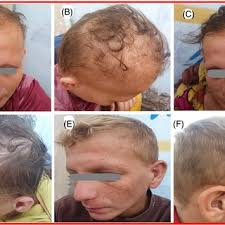 PDF) Novel splicing‐site mutation in DCAF17 gene causing Woodhouse‐Sakati  syndrome in a large consanguineous family