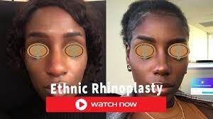 I got my rhinoplasty (nose job) with dr. Ethnic Rhinoplasty African American Asian Nose Job Before After Gallery