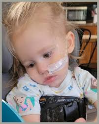 Experiences with Baby Helmets for Craniosynostosis