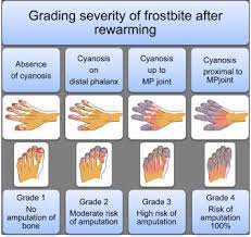 Ue3 and ue4 are also. A New Proposal For Management Of Severe Frostbite In The Austere Environment Wilderness Environmental Medicine