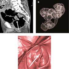 Colon cancer symptoms in cats come on so gradually that they may not become noticeable until the disease is in its late stages. Imaging Of Colorectal Cancer The Clue To Individualized Treatment