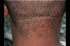 How To Cure Razor Bump At The Back Of The Neck