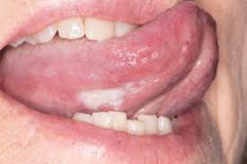 Image result for white cancer on tongue)