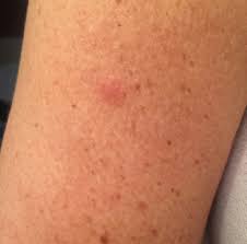 Autoimmune Progesterone Dermatitis With Delayed Intradermal Skin Reaction Annals Of Allergy Asthma Immunology