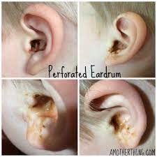 Sep 03, 2020 · a ruptured or perforated eardrum is a hole or tears in the eardrum (tympanic membrane). Perforated Eardrum In Toddlers
