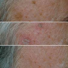 Image result for Solar Lentigo