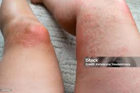 Image result for allergy rash on the legs