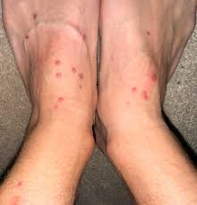 Image result for mite bites on humans