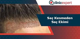 Sac Kesmeden Sac Ekimi Islemi Clinicexpert Sac Ekim Merkezi