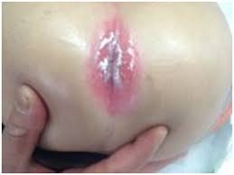 Test De Diagnostico Rapido Para Estreptococo Pyogenes En El Diagnostico De La Dermatitis Celulitis Perianal Estreptococica Sepeap